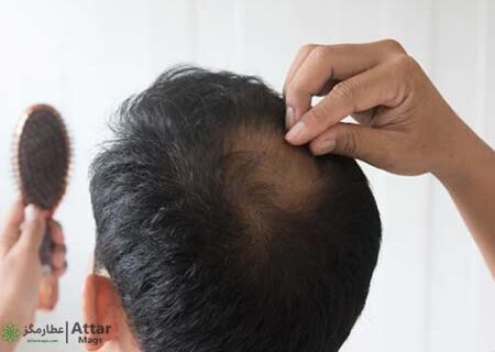 درمان ریزش مو در طب سنتی